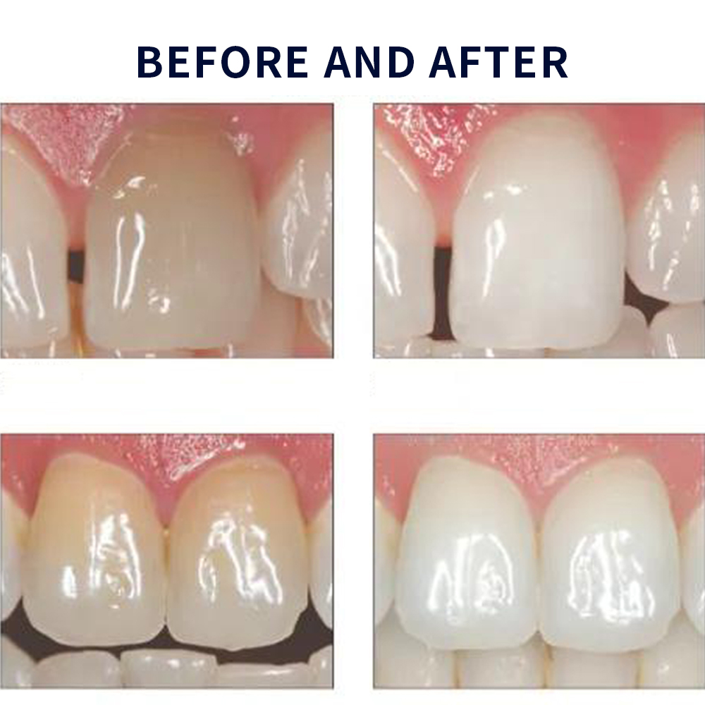Opalescence Whitening 20% PF 2 - Teeth Whitening Flash ulasan dan harga