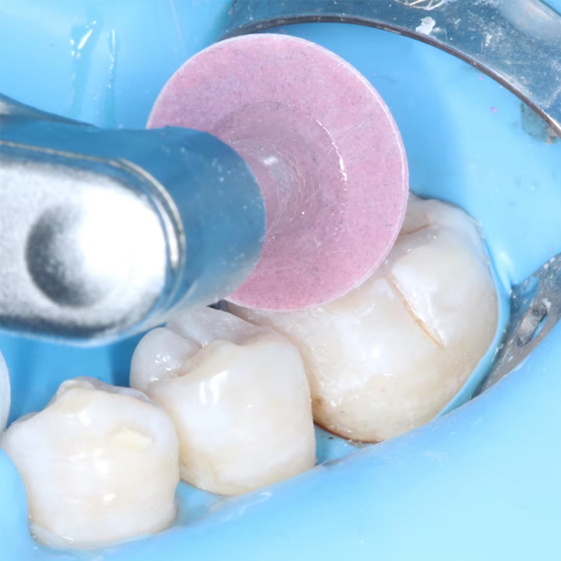 40Pcs Disc Poles Gigi Resin Ko - Teeth Whitening Uk ulasan dan harga