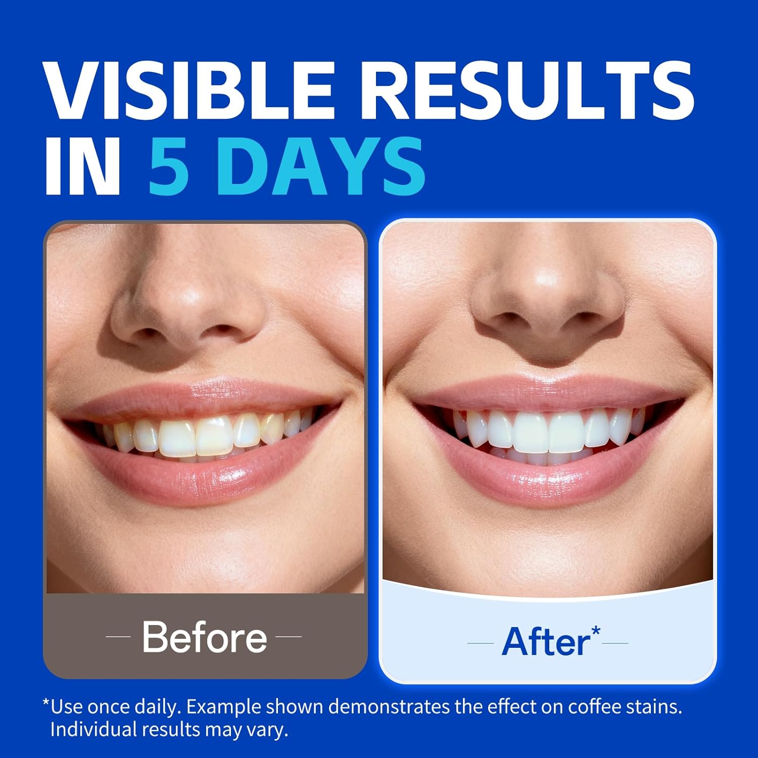 7 pasang Strip Pemutih Gigi un - Teeth Whitening Retainer ulasan dan harga