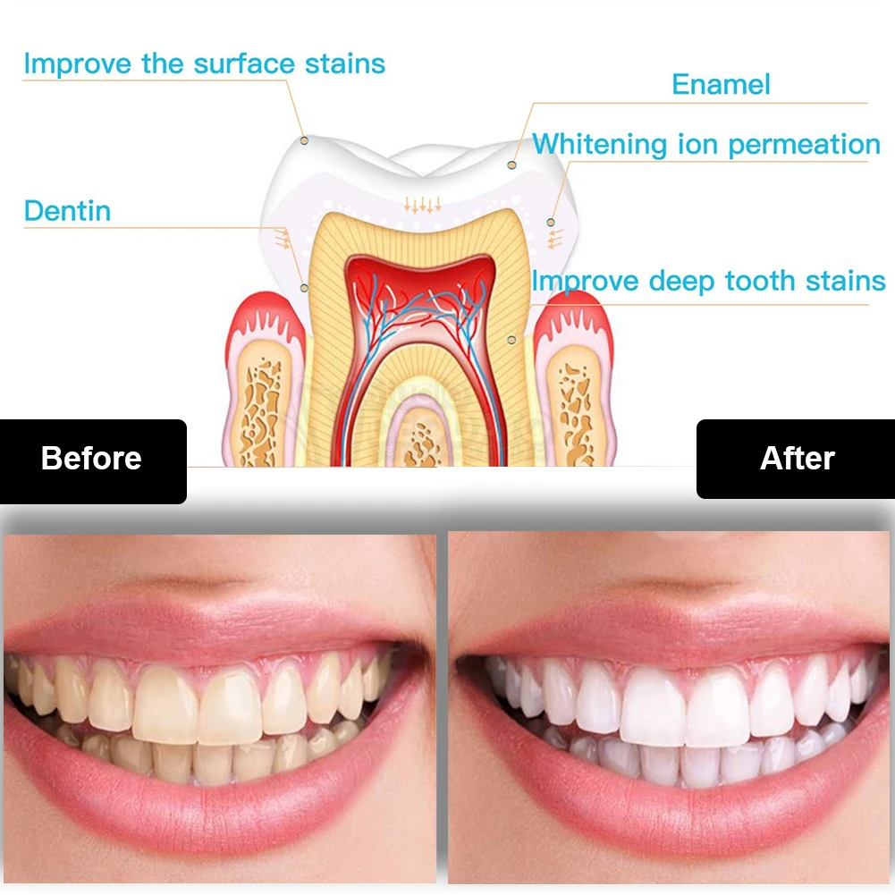 Kit pemutih gigi Mini 16 LED c - Teeth Whitening Flash ulasan dan harga
