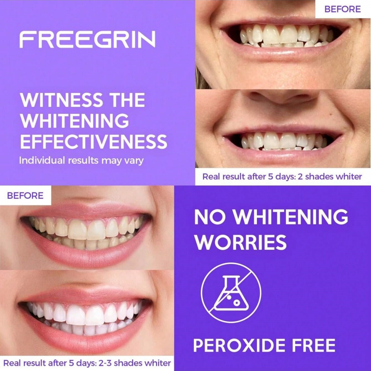Stiker Gigi Pemutih Mewah 7/14 - Teeth Whitening Retainer ulasan dan harga